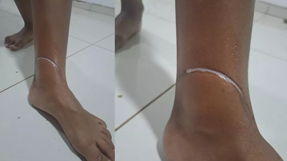 Fiação solta volta a causar acidente em Patos: gestante e filha de 8 anos caem de moto após se enroscarem em cabo de internet