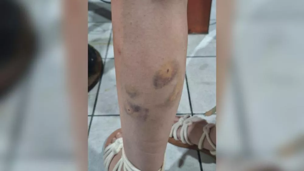 Jovem é atacada por cães no bairro Novo Horizonte, em Patos, e precisa tomar vacinas após o incidente