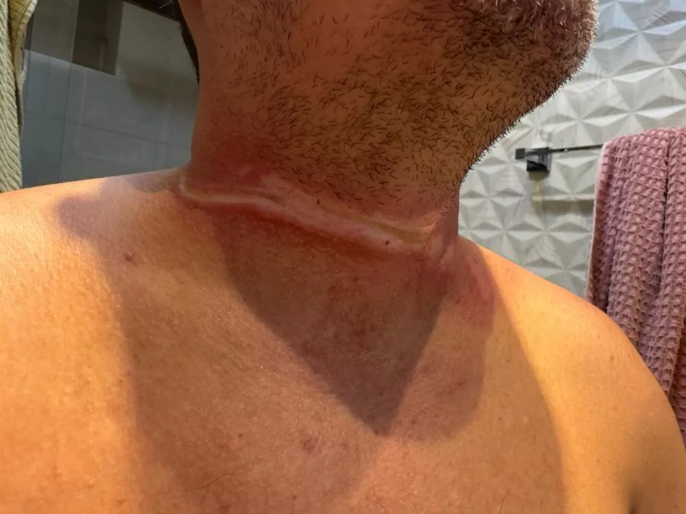 Empresário relata acidente causado por fio de internet baixo em rua de Patos e cobra providências 