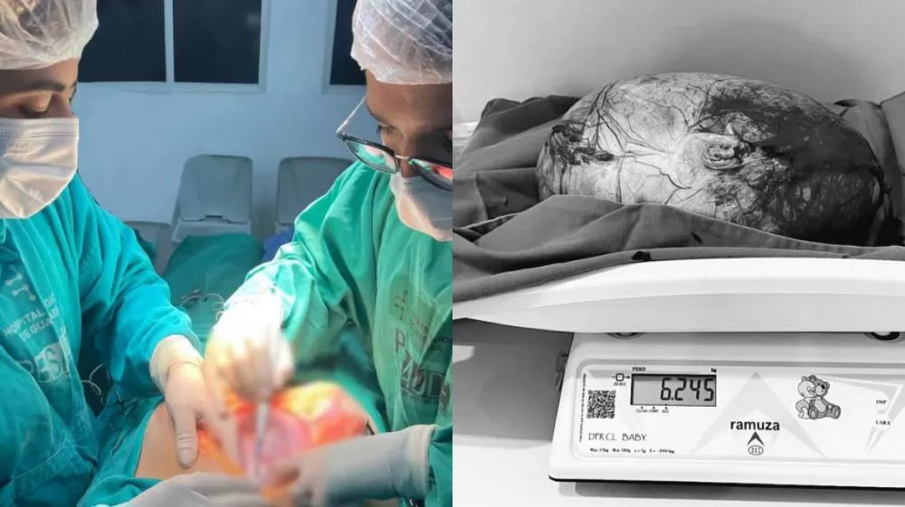 Hospital Regional de Guarabira realiza cirurgia de urgência para retirada de cisto ovariano com mais de 6kg