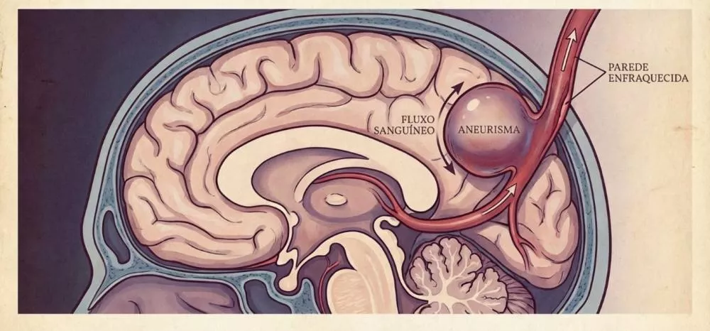 Dr. Romulo José alerta sobre aneurisma cerebral e reforça importância do diagnóstico precoce