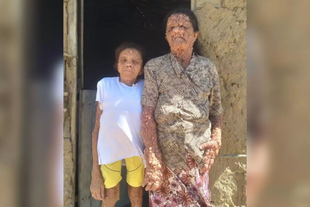 Neurofibromatose: mãe e filha na Paraíba convivem com doença rara que atravessa gerações: 'O povo se afasta da gente, mas entrego na mão de Deus’