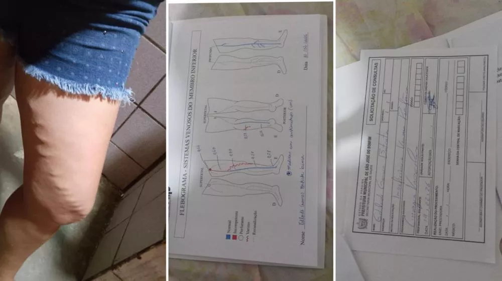 Jovem de São José do Bonfim pede ajuda para custear cirurgia vascular de R$ 14 mil após diagnóstico de comprometimento da veia safena