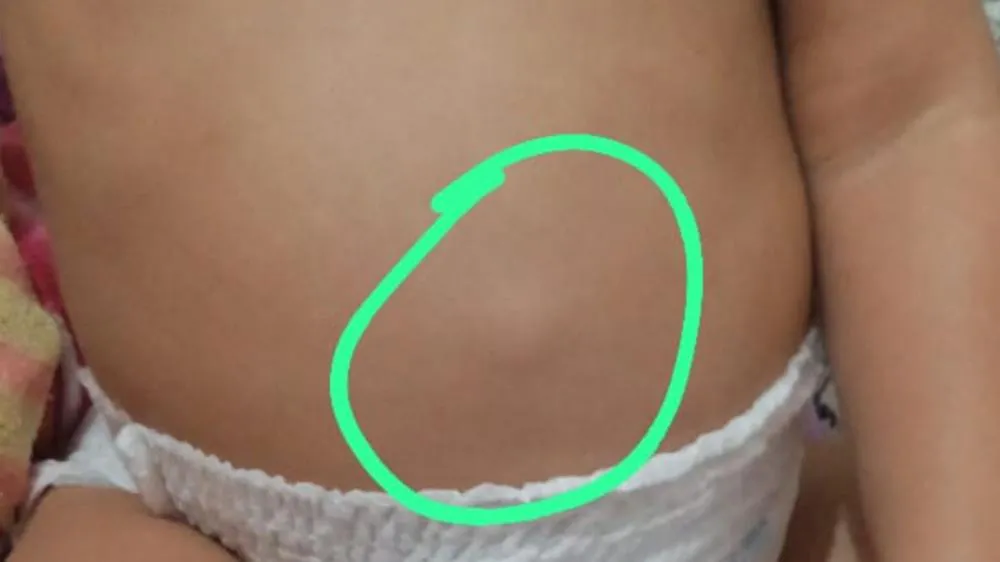 Mãe denuncia demora na cirurgia de criança com hérnia, em Patos, e relata agravamento do quadro