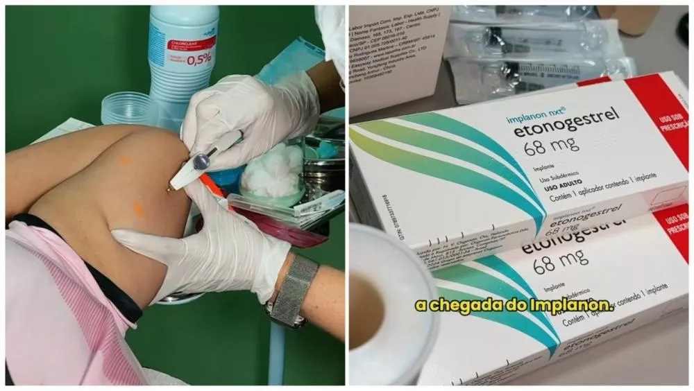 Cacimbas inicia oferta gratuita de Implanon e amplia acesso a método contraceptivo de alta eficácia