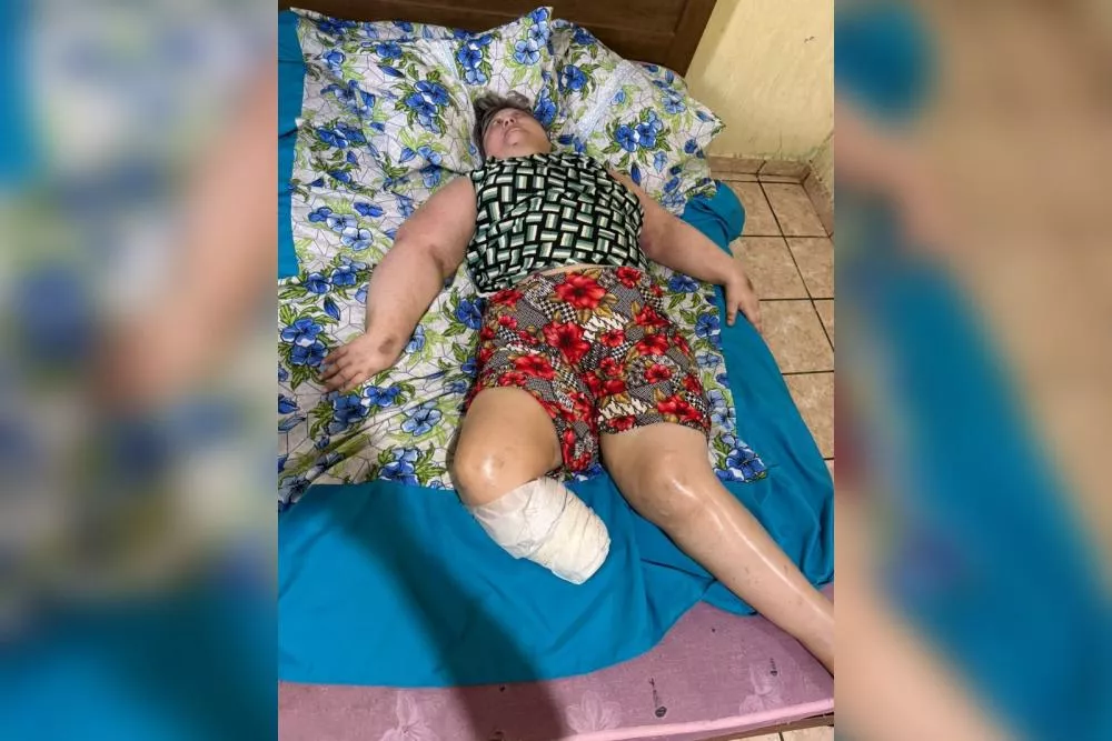 Campanha solidária busca arrecadar recursos para compra de cama hospitalar para moradora de Patos após amputação