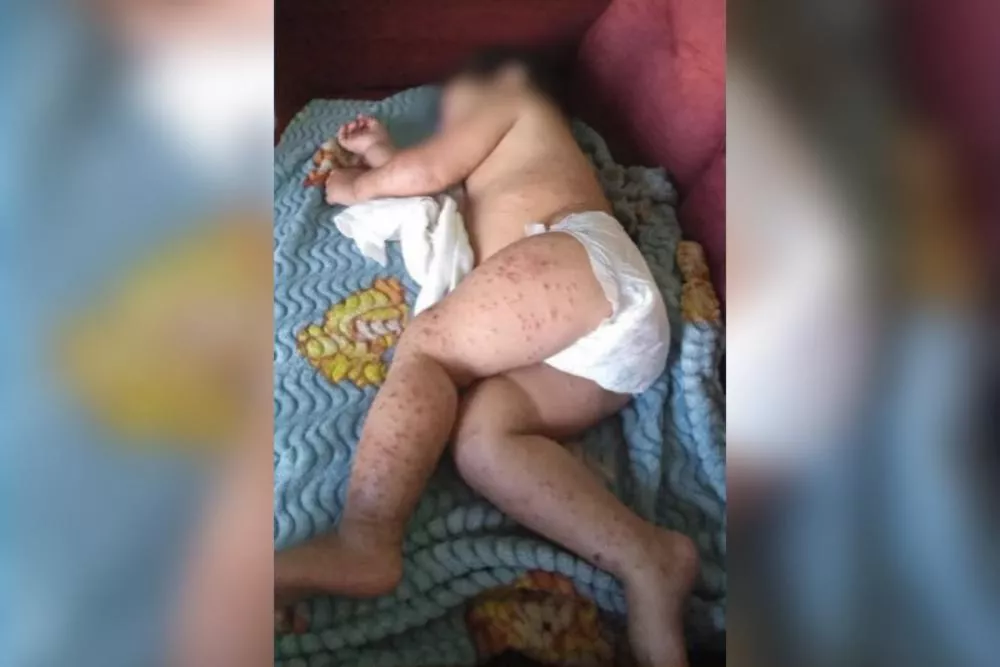 Mãe faz apelo por ajuda para custear consulta com dermatologista para bebê de 1 ano e 6 meses, em Patos