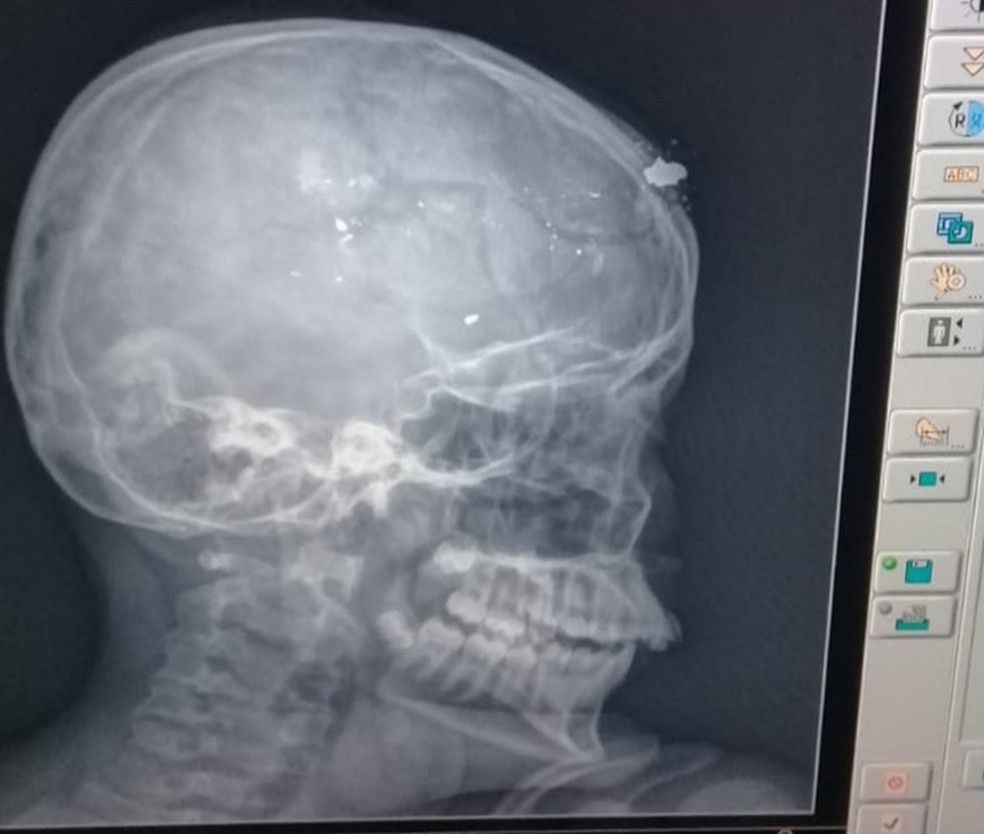 Criança baleada na cabeça por irmão evolui quadro clínico e respira sem aparelhos