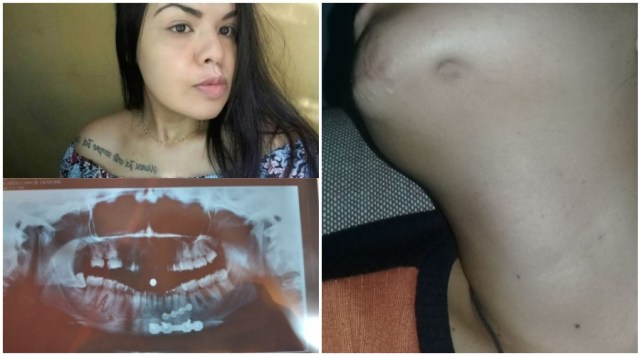 Família de Teixeira pede ajuda para cirurgia buco-maxilo-facial de jovem que custa R$4 mil