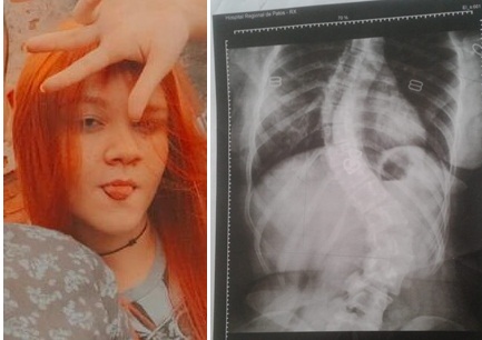 Em Patos: Mãe faz apelo emocionado para conseguir realizar cirurgia da filha no valor de R$ 35 mil reais. Saiba mais